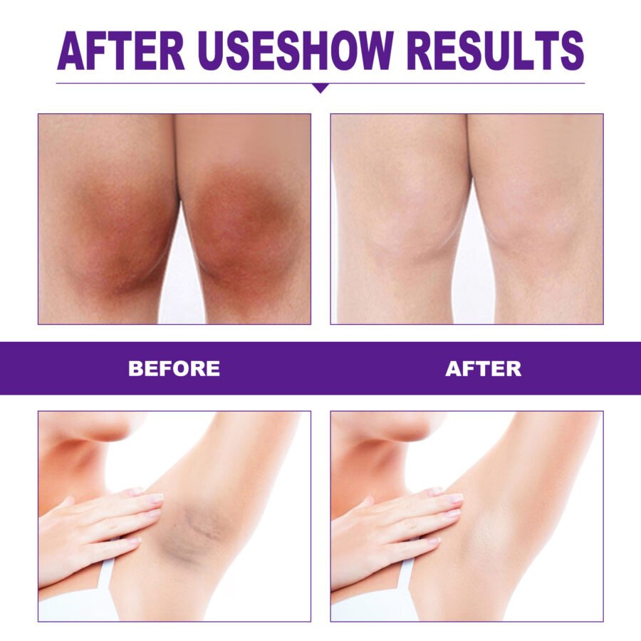 EELHOE Rejuvenator Areola Intimate Area Rejuvenator Lip Joints Melanin Removal